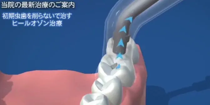 ヒールオゾン治療
